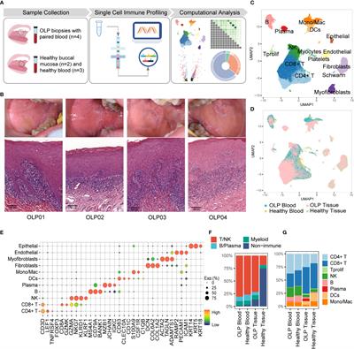 Single-cell immune profiling reveals immune responses in oral lichen planus